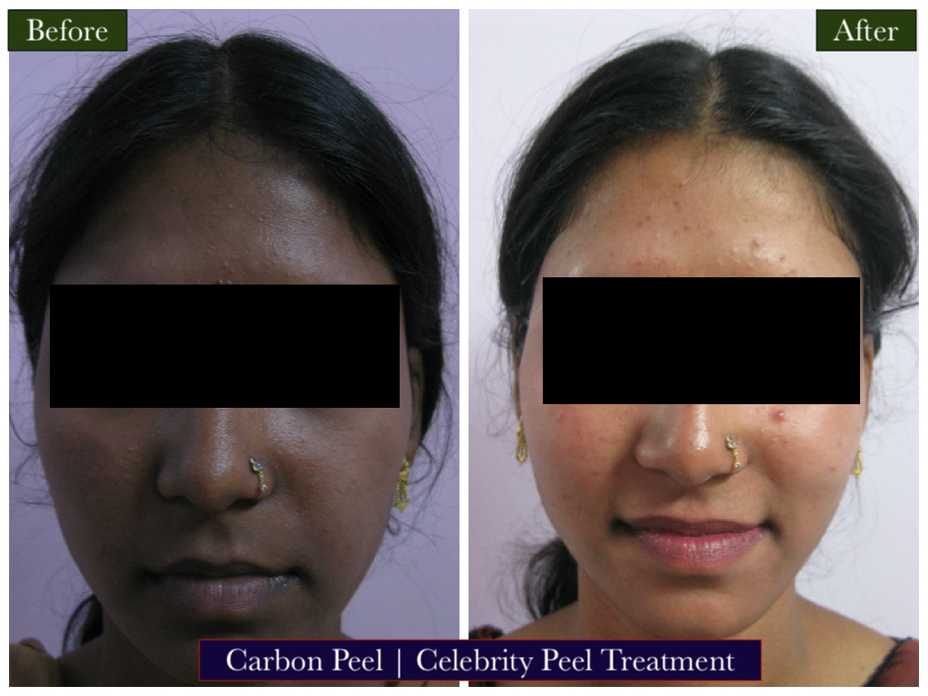 Carbon Peel Treatment